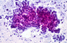 ep cancerpancreas 20190315124514