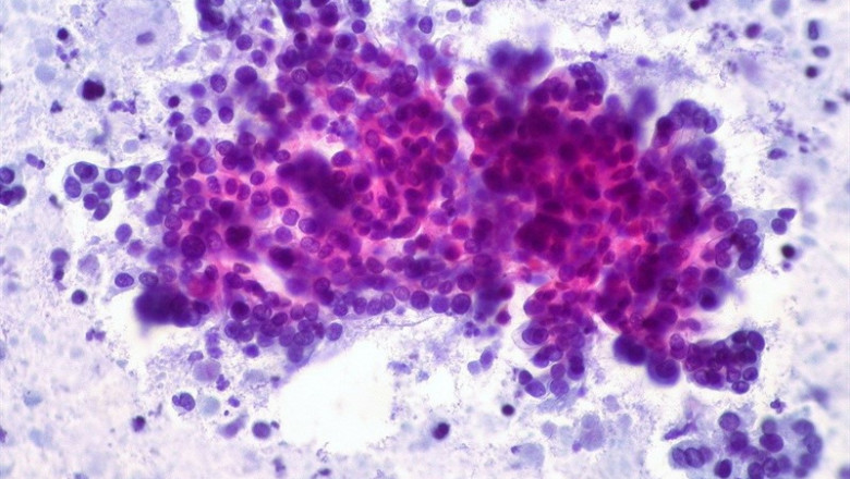 Cáncer de páncreas | FLICKR ED UTHMAN - Archivo ep cancerpancreas 20190315124514