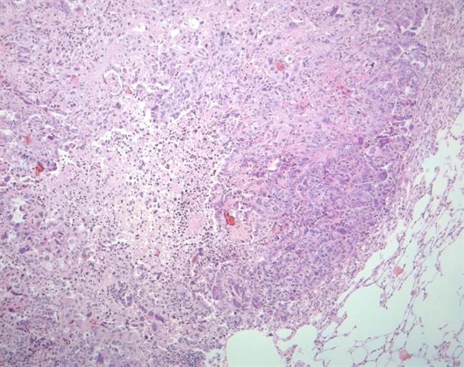 ep cancerpulmon
