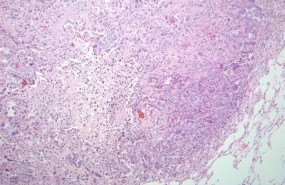 ep cancerpulmon