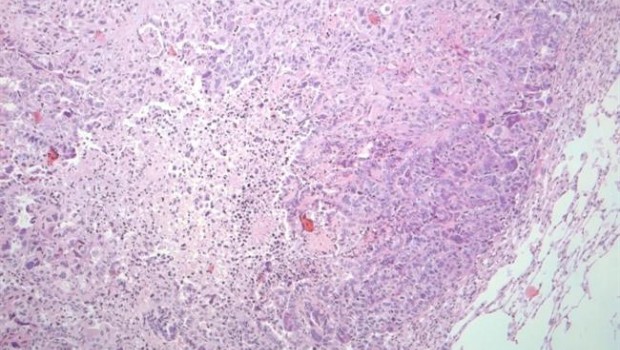 ep cancerpulmon