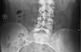 ep escoliosis