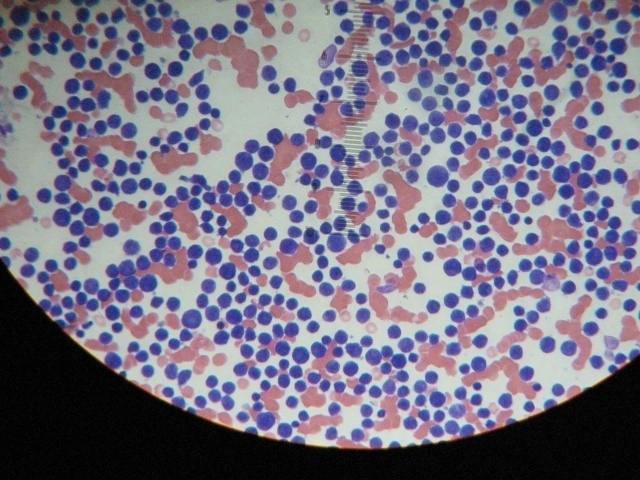 ep leucemia 20171122110202
