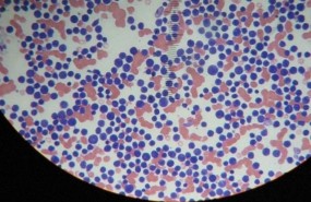 ep leucemia 20171122110202