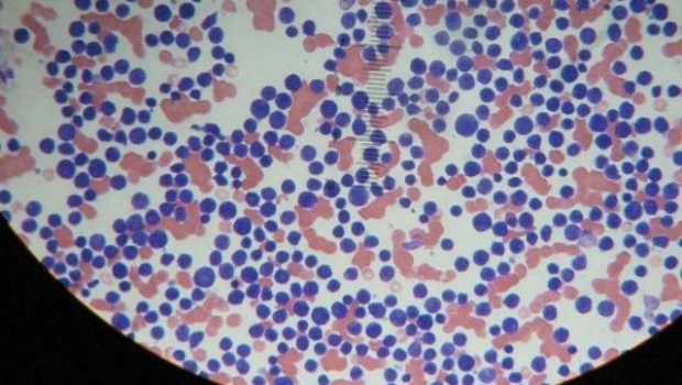 ep leucemia 20171122110202