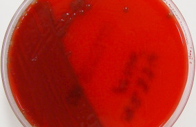 ep meningitis