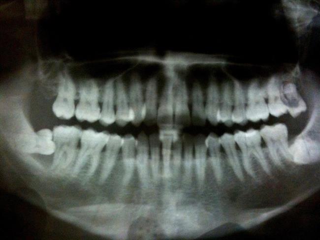 ep periodontitis