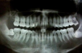 ep periodontitis