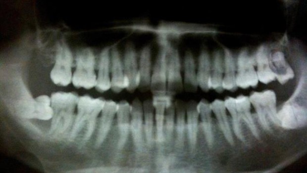 ep periodontitis