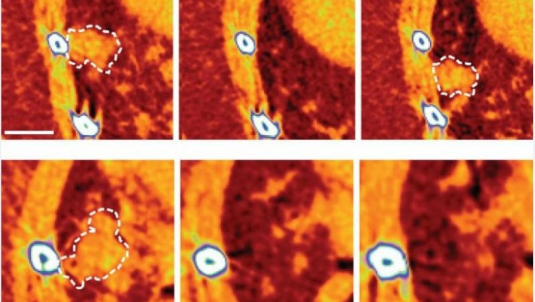 Imágenes que muestran un tumor pulmonar de ratón que recae después de la terapia dirigida (arriba), y un tumor pulmonar de ratón tratado con Quisinostat después del tratamiento inicial (abajo). El tumor tratado con Quisinostat no volvió a crecer. | FRANCIS CRICK INSTITUTE ep imagenes que muestran un tumor pulmonar de raton que recae despues de la terapia dirigida arriba