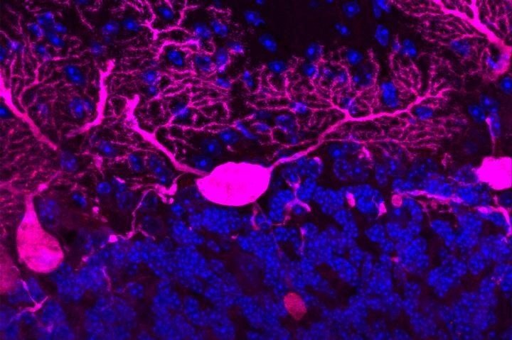 Cuando el sistema que transporta las moléculas a través de las largas ramas de las neuronas (rosadas) se descompone, el caos se produce lentamente. | THE ROCKEFELLER UNIVERSITY ep cuando el sistema que transporta las moleculas a traves de las largas ramas de las neuronas