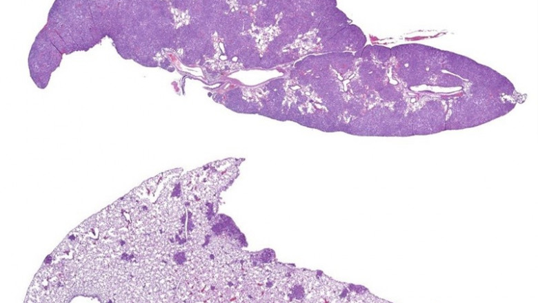 La imagen superior muestra tumores pulmonares (morados oscuros) en ratones del grupo de control en comparación con los que carecen de CRTC2 (inferior), lo que sugiere el potencial terapéutico de los fármacos que pueden interferir con CREB o CRTC2. | SALK INSTITUTE ep la imagen superior muestra tumores pulmonares morados oscuros en ratonesgrupocontrolcomparacionloscarecencrtc2 inferior losugierepotencial terapeuticolos farmacospueden interferircrebcrtc2