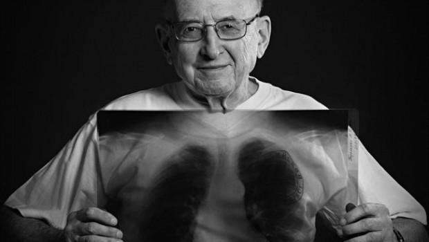 ep tuberculosis 20170323181102