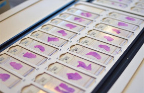 ep un estudio pionero demuestra el impacto del perfil molecular en la evolucion del cancer