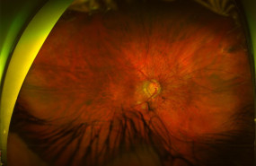 1591633884 desprendimiento de retina