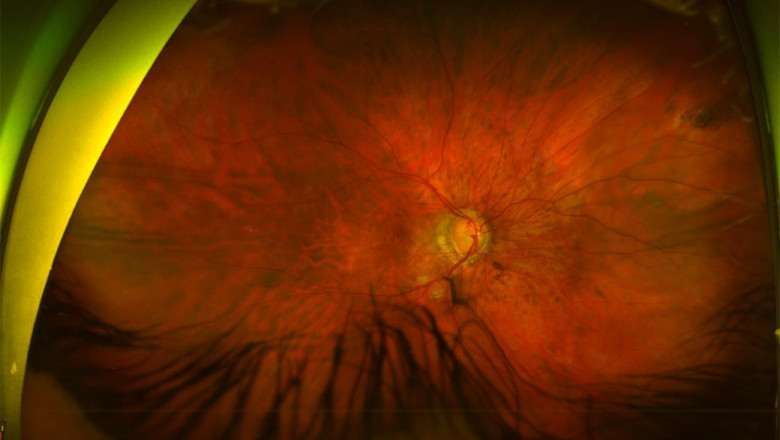 1591633884 desprendimiento de retina