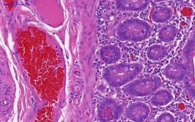 Intestino humano de un paciente con enfermedad inflamatoria intestinal. | UNIVERSIDAD DE MANCHESTER ep intestino humanoun pacienteenfermedad inflamatoria intestinal
