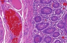 ep intestino humanoun pacienteenfermedad inflamatoria intestinal