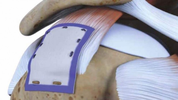 smith nephew rotation medical rotator cuff shoulder smith nephew rotation medical rotator cuff shoulder