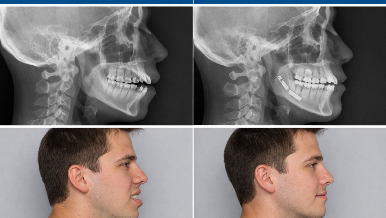 cirugia ortognatica policlinica gipuzkoa 