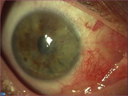 “Pterigium Avanzado” Caso Anterior Tras Cirugía Con Injerto Conjuntival | CENTRO DE INVESTIGACIÓN BIOMÉDICA EN RED (CIBER) ep pterigium avanzado caso anteriorcirugiainjerto conjuntival