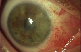 ep pterigium avanzado caso anteriorcirugiainjerto conjuntival