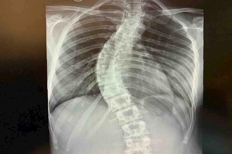 ep radiografia escoliosis
