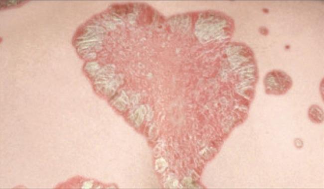 A la psoriasis que no es posible beber