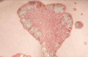 ep placaspsoriasis