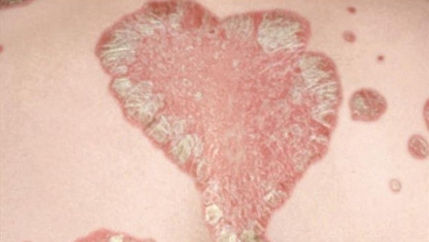 ep placaspsoriasis