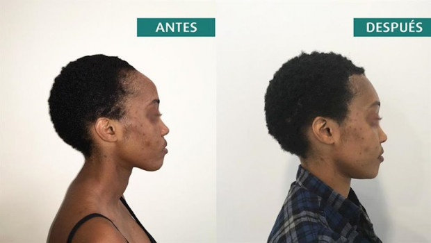 ep frontoplastia