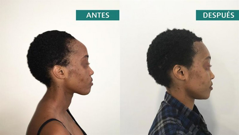ep frontoplastia