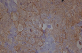 ep metastasis cancerovario 20190430185413