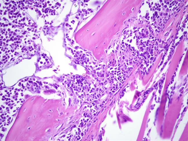 ep lesion liticamodelomieloma multiple csic