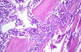 ep lesion liticamodelomieloma multiple csic