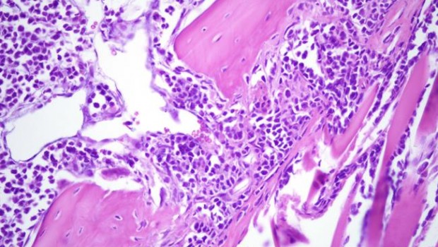 ep lesion liticamodelomieloma multiple csic