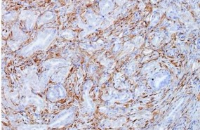 ep celulas tumoralescancerpancreas mostrandomarrongalectina 1