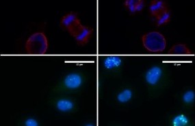 ep las celulasmelanoma adictasla proteina loxl3