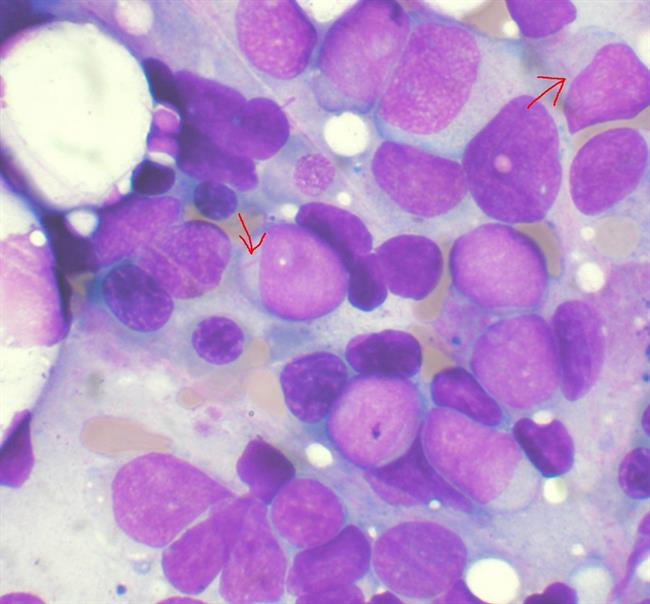 Leucemia mieloide aguda | CIBER ep leucemia mieloide aguda