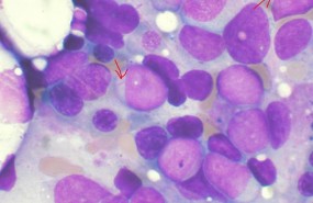 ep leucemia mieloide aguda