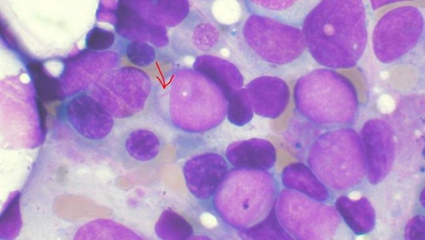 ep leucemia mieloide aguda