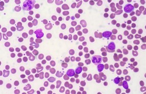 ep leucemia linfatica cronica llc