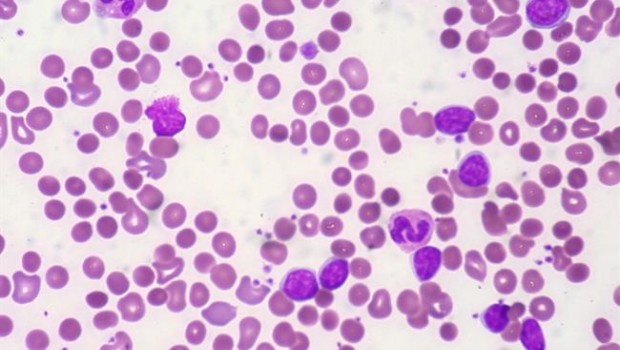 ep leucemia linfatica cronica llc