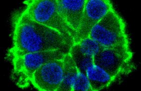 ep crecimiento acinarcelulas tumoralesmodelo 3dmicroambiente tumoral