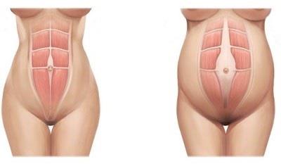 ep diastasisrectos abdominales