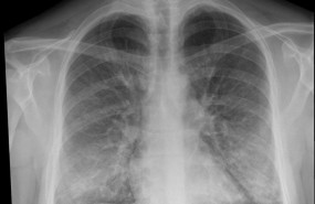 ep radiografia de torax