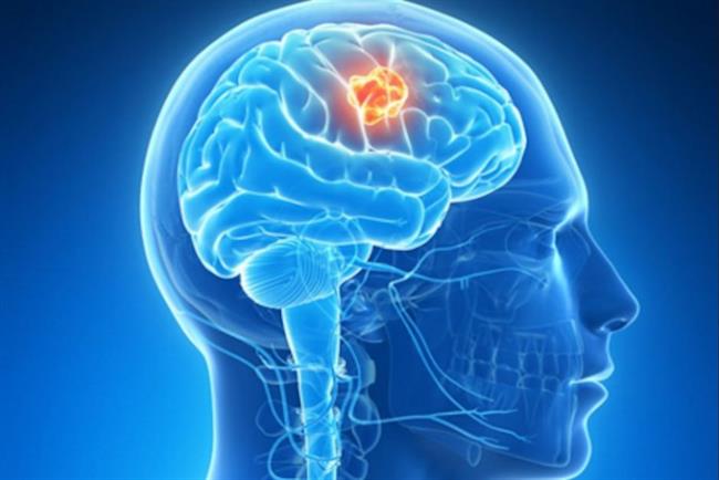 Tumor cerebral | FLICKR ep tumor cerebral