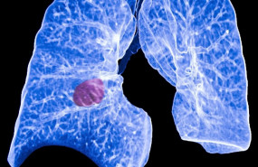 ep cancerpulmon 20190820172604