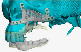 vistas del implante con respecto a la enca vistas del implante con respecto a la enca